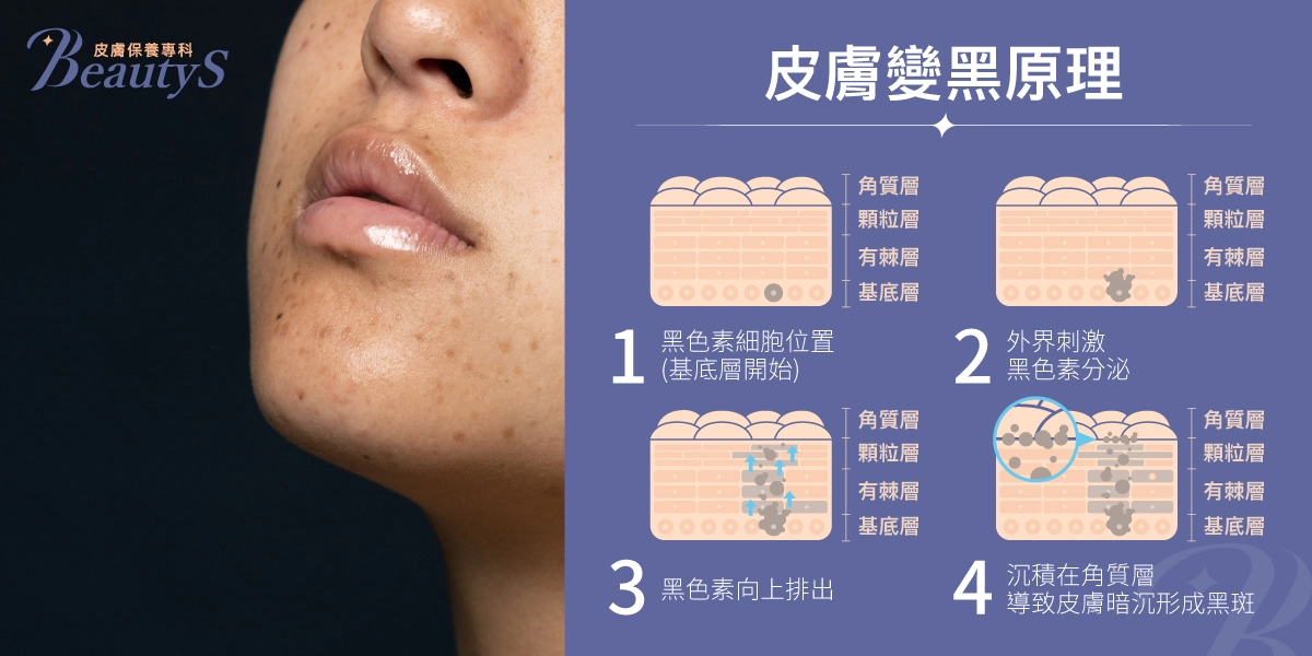 皮膚變黑原理：黑色素細胞位置(基底層開始)、外界刺激黑色素分泌、黑色素向上排出、沉積在角質層，導致皮膚暗沉形成黑斑