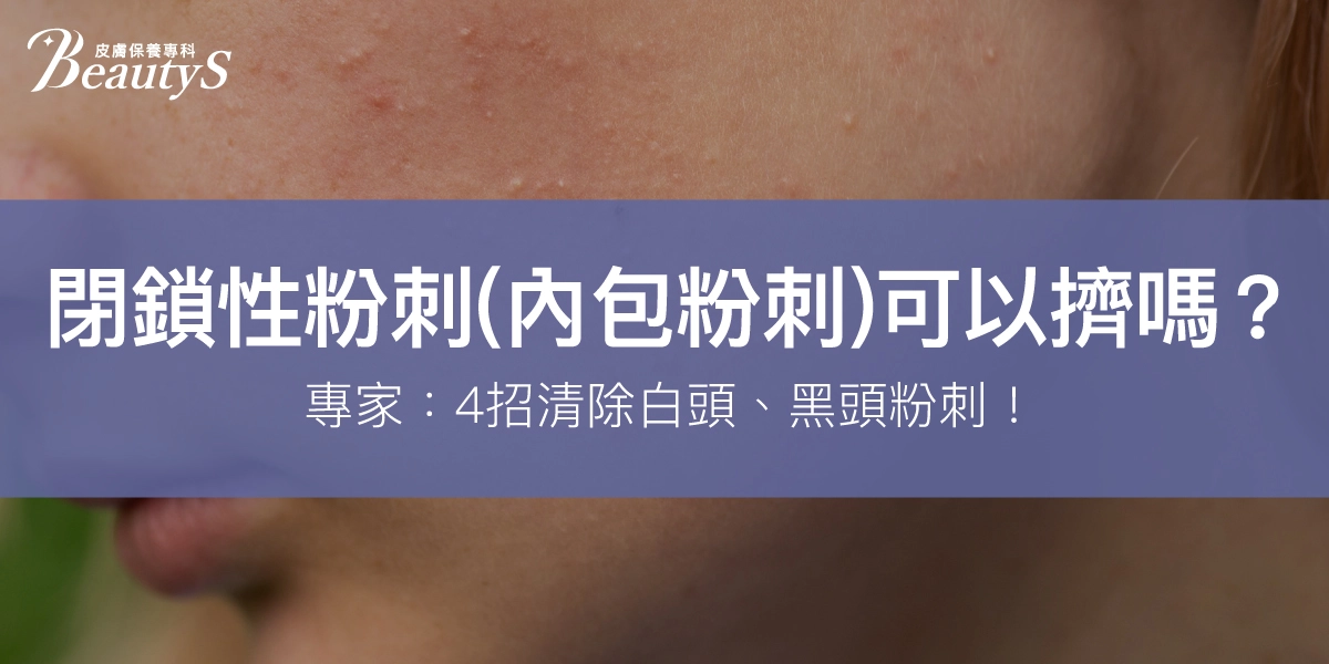 閉鎖性粉刺(內包粉刺)可以擠嗎?專家:別擠!有4招快速清除!