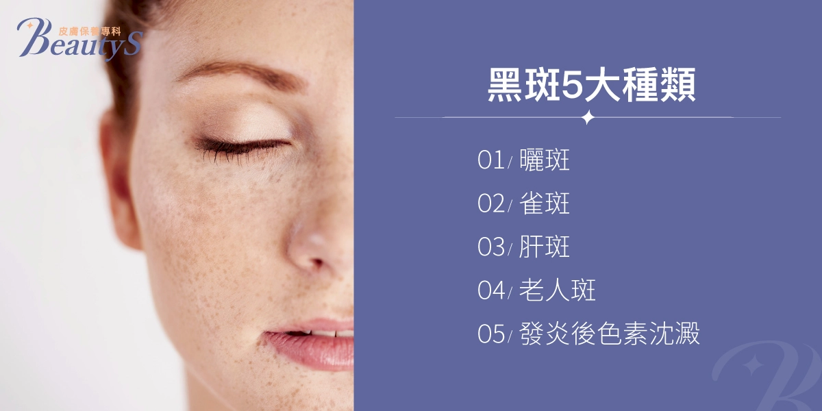黑斑5大種類:曬斑、雀斑、肝斑、老人斑、發炎後色素沈澱