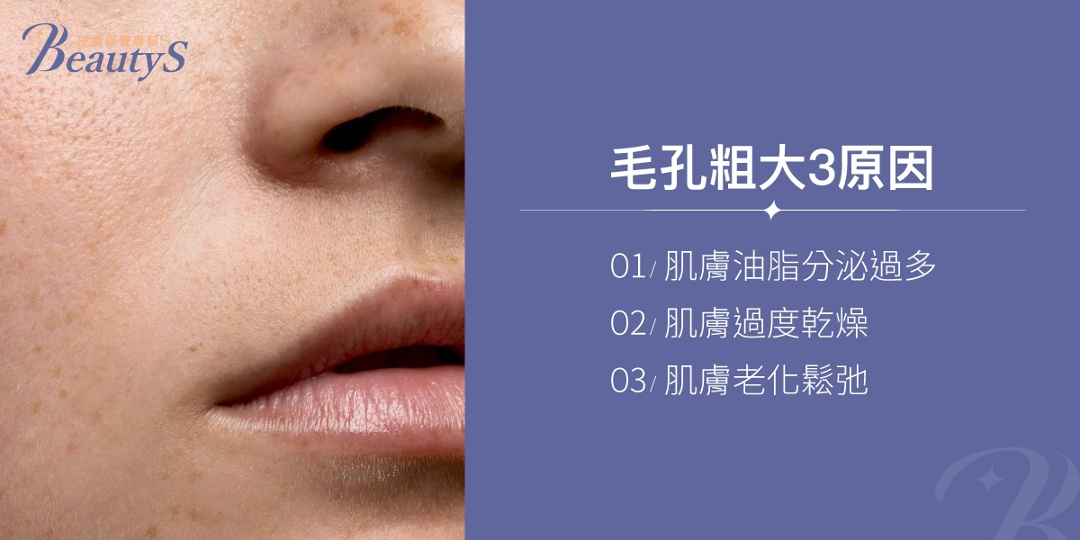 毛孔粗大3原因，包括：肌膚油脂分泌過多、肌膚過度乾燥、肌膚老化鬆弛。
