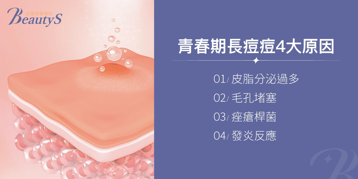 青春期長痘痘4大原因:皮脂分泌過多、毛孔堵塞、痤瘡桿菌、發炎反應