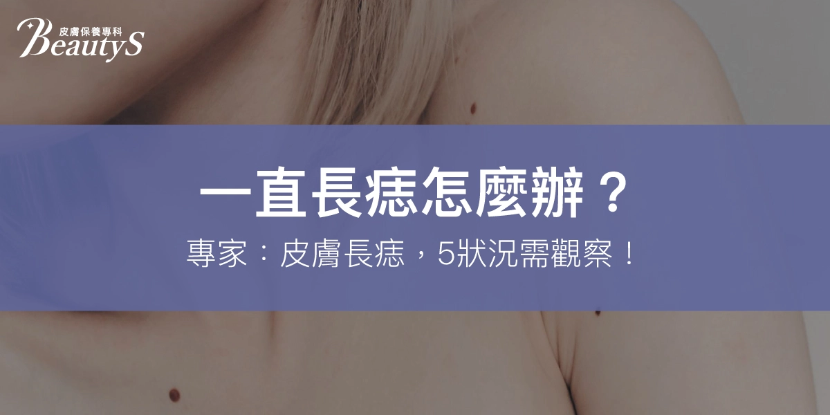 一直長痣怎麼辦？專家：皮膚長痣5狀況觀察，痣變大要看醫生！