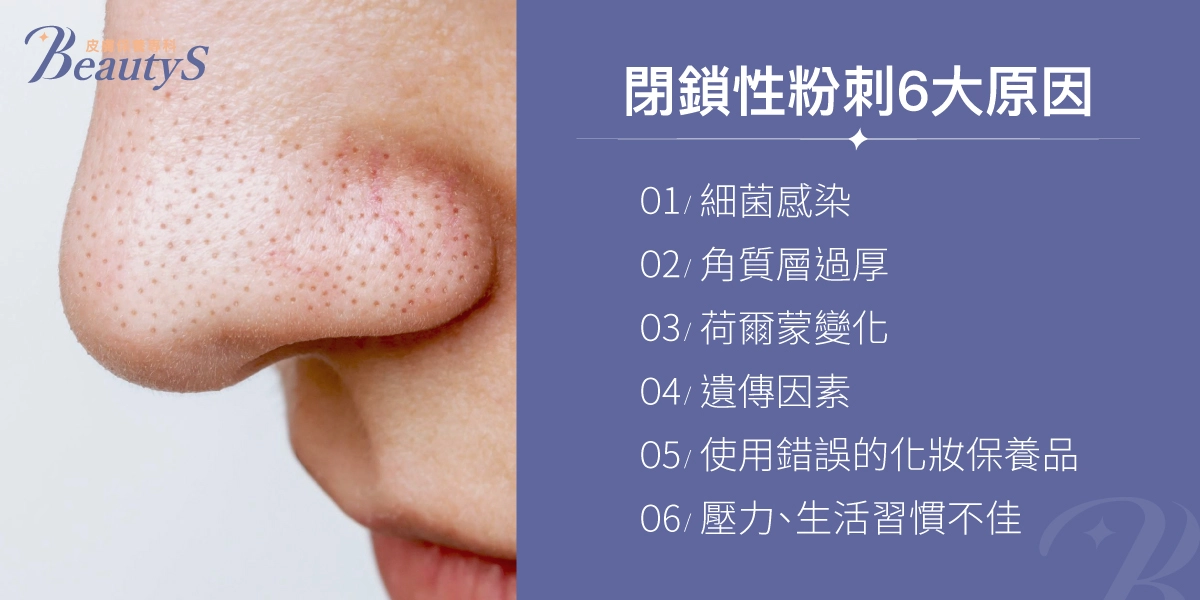 閉鎖性粉刺6大原因:細菌感染、角質層過厚、荷爾蒙變化、遺傳因素、使用錯誤的化妝保養品、壓力、生活習慣不佳