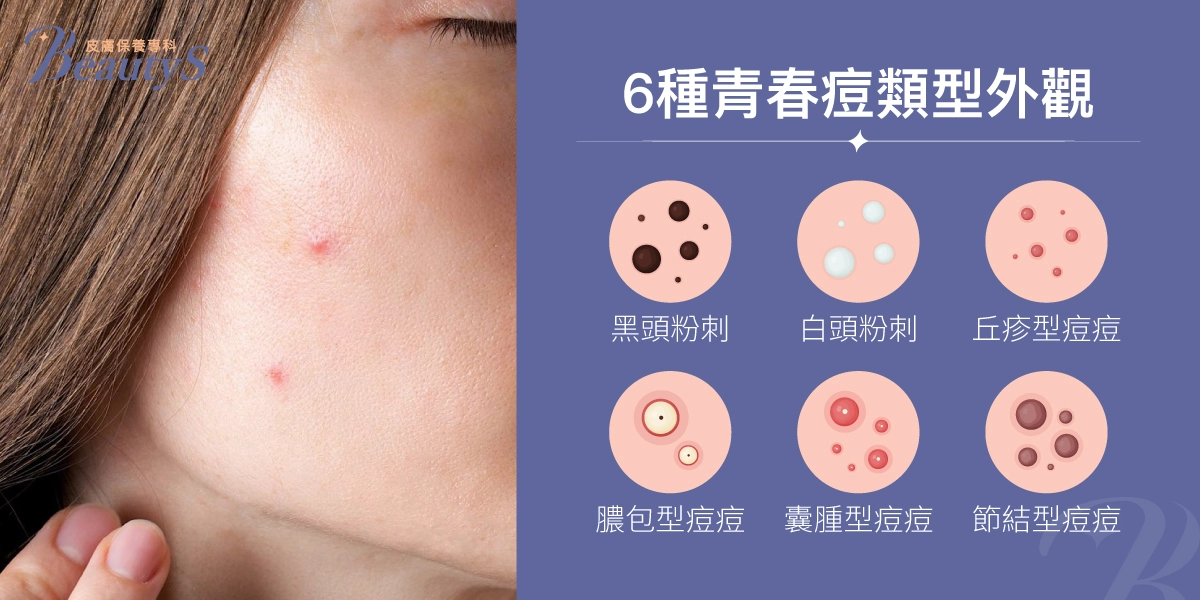 6種青春痘類型外觀:黑頭粉刺、白頭粉刺、丘疹型痘痘、膿皰型痘痘、結節型痘痘、囊腫型痘痘