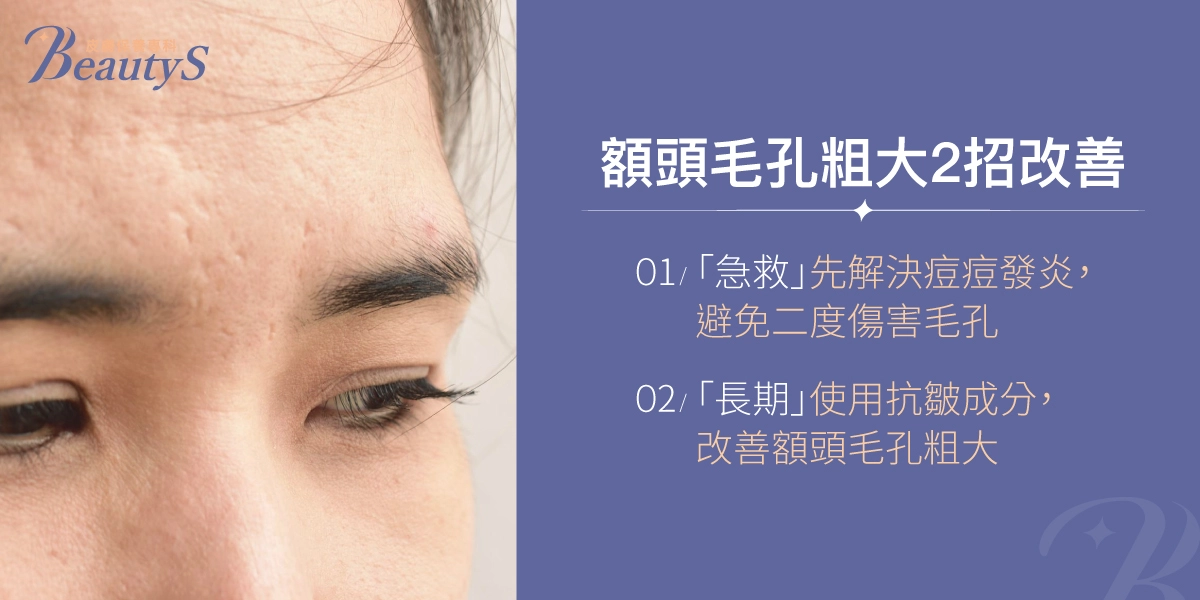 額頭毛孔粗大2招改善:「急救」先解決痘痘發炎,避免二度傷害毛孔、「長期」使用抗皺成分,改善額頭毛孔粗大