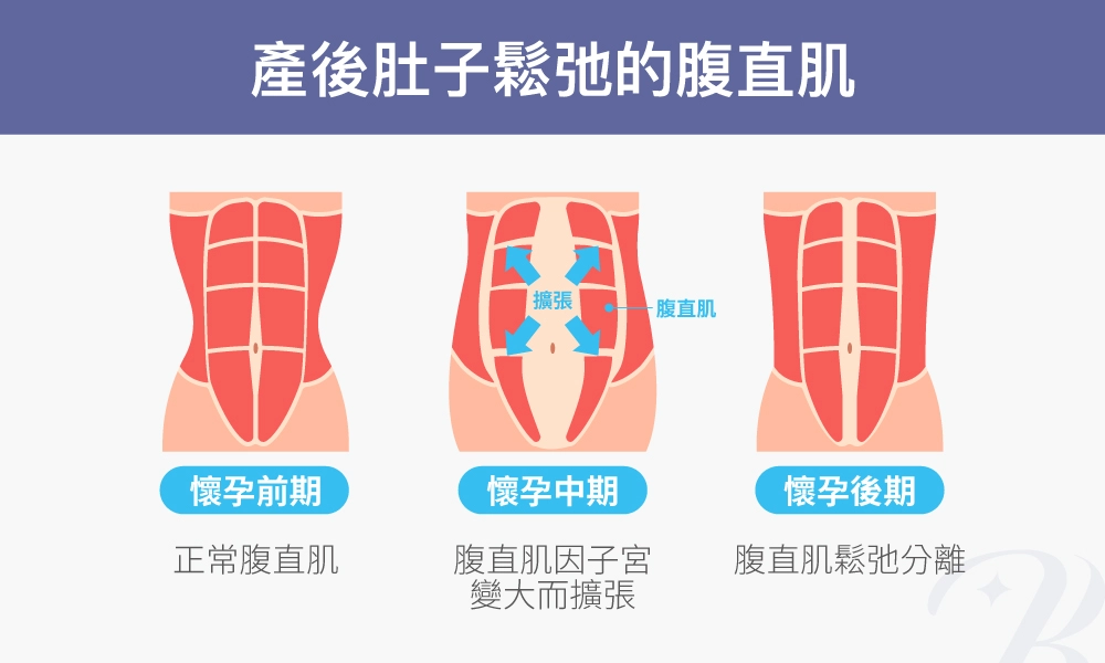 產後肚子鬆弛的腹直肌變化:懷孕前期,正常腹直肌;懷孕中期,腹直肌因子宮變大而擴張;懷孕後期,腹直肌鬆弛分離。