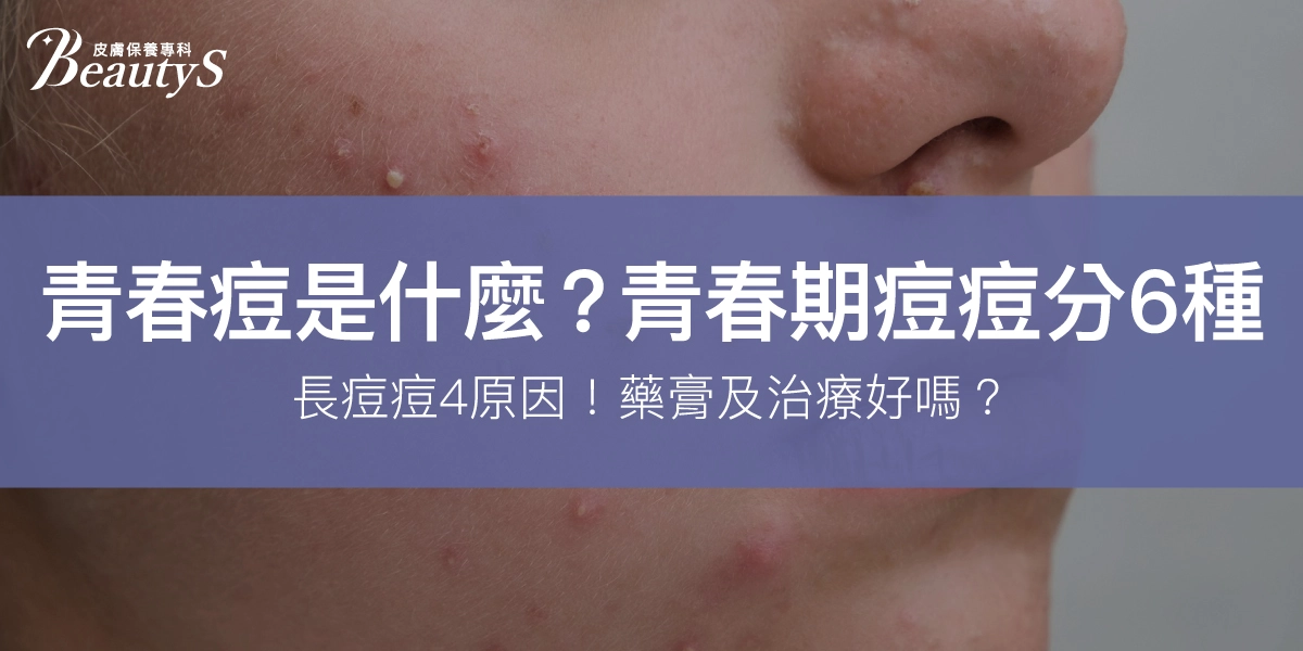 青春痘是什麼?青春期痘痘分6種、長痘4原因!藥膏及治療好嗎?